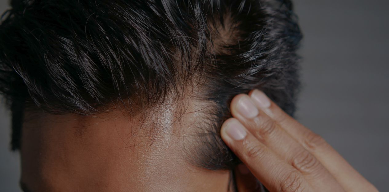 Anamnese bei Haarausfall für individuelle Diagnostik Anamnese bei Haarausfall für individuelle Diagnostik