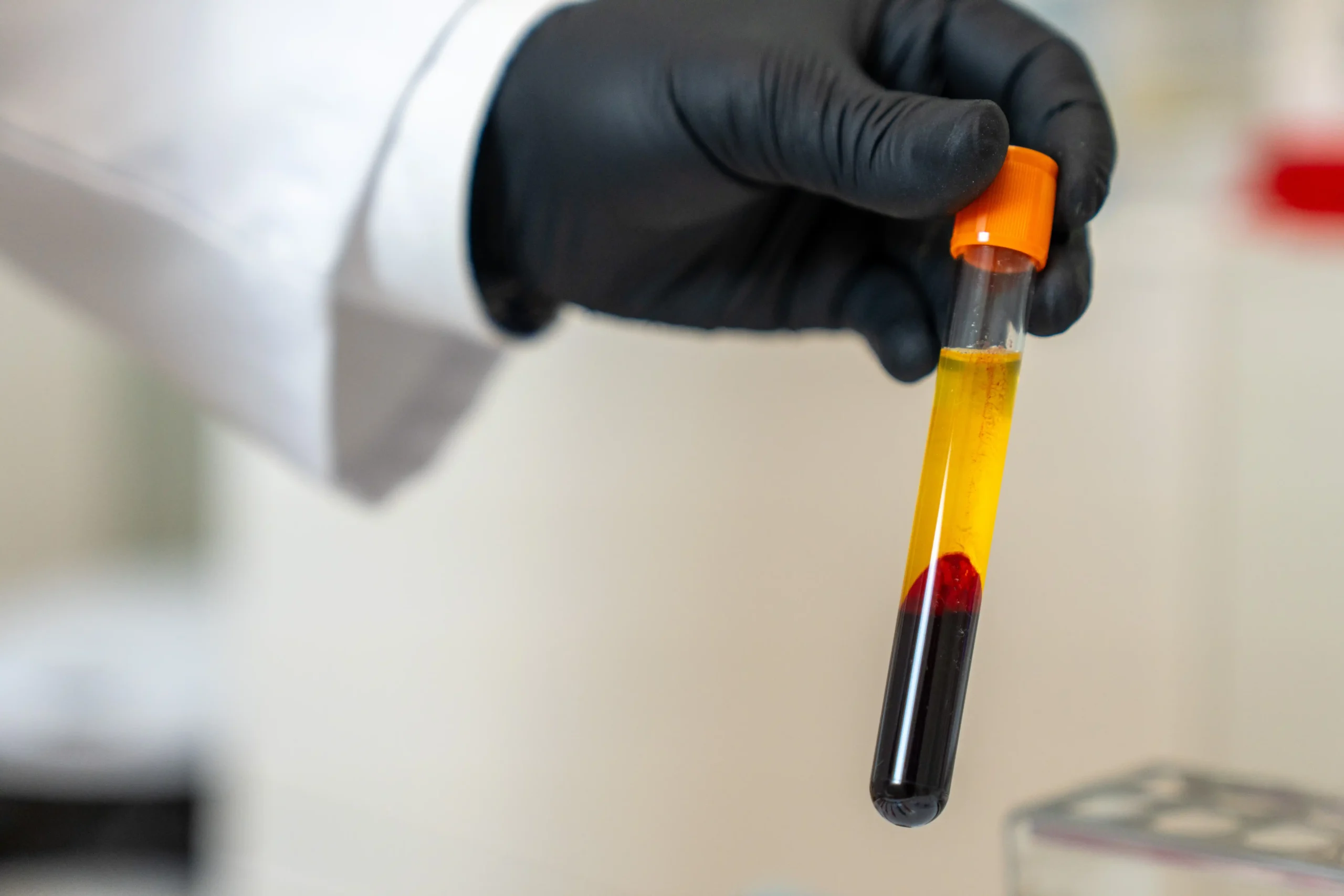 Eigenblut-Therapie mit PRF Eigenblut-Therapie mit PRF