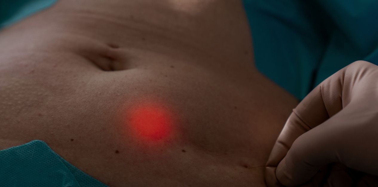 Endolift für straffe Haut ohne OP Endolift für straffe Haut ohne OP