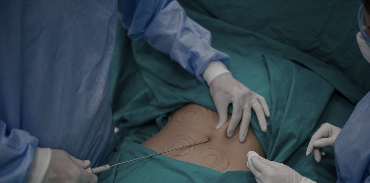 Fettabsaugung für definierte Körperformen Fettabsaugung für definierte Körperformen