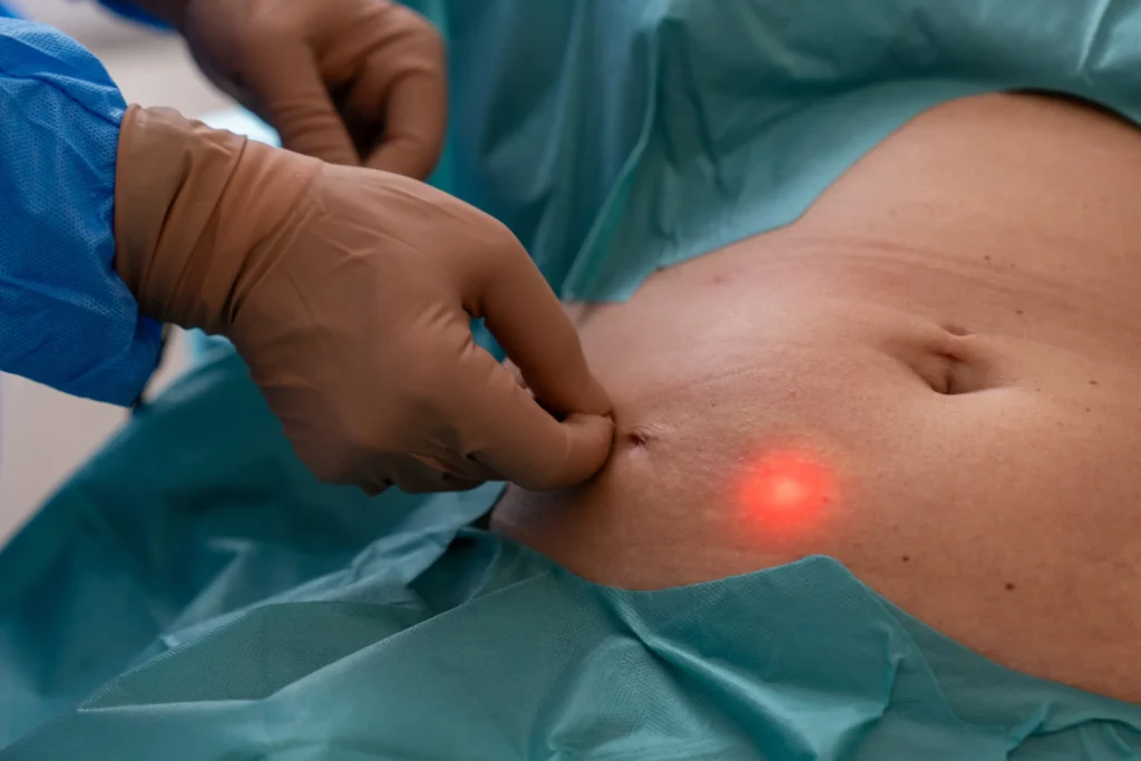 Endolift Behandlung in Berlin