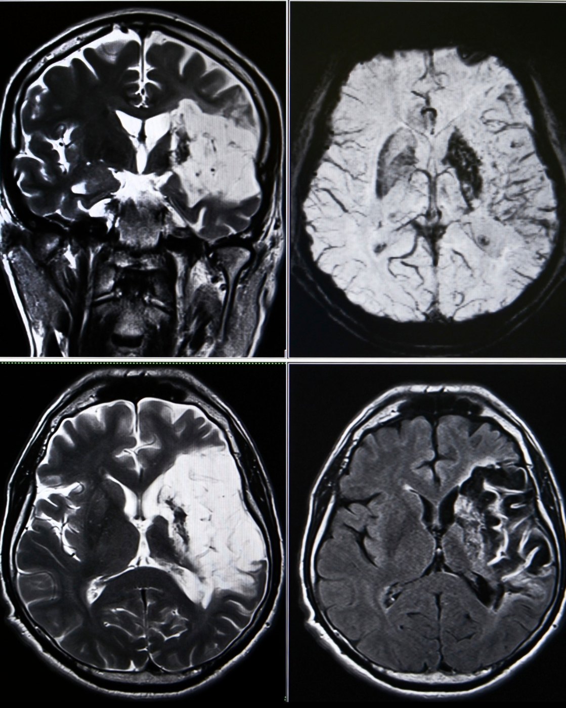 MRT des Kopfes nach Schlaganfall: Hirninfarkt im Versorgungsgebiet der Arteria cerebri media in vier Sequenzen